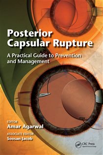 Posterior Capsular Rupture A Practical Guide to Prevention and Management