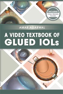 A Video Textbook of Glued IOLs