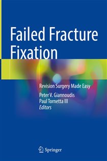 Failed Fracture Fixation Revision Surgery Made Easy