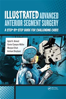 Illustrated Advanced Anterior Segment Surgery A Step-by-Step Guide for Challenging Cases